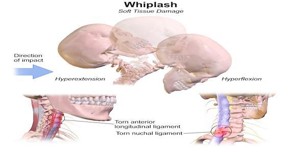 Did You Sustain Whiplash in a Crash?